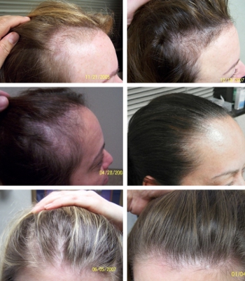 Female Hair Loss Treatments: Before and After Photos