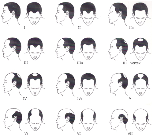 Norwood Hamilton Scale of Male Hair Loss