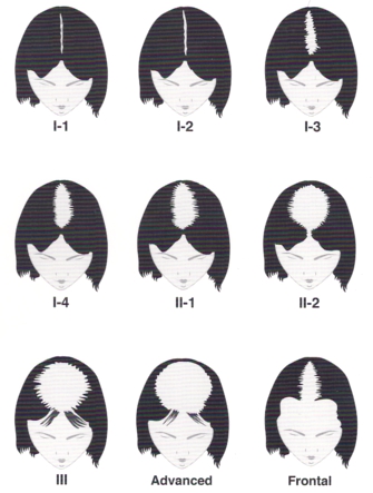 Ludwig Scale of Female Hair Loss