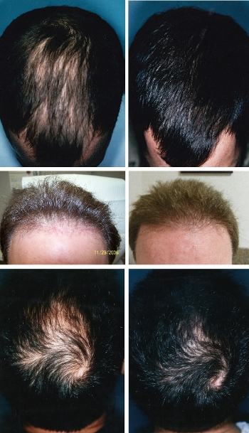 Male Hair Loss Treatments: Before and After Photos