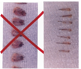 Hair loss treatments: transplant surgery