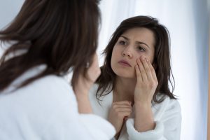 bruising with fillers