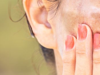 How do I treat melasma if it seems to be getting worse? Dr. Irwin answers on SkinTour skin care blog