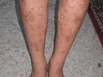 skin problems Dr. Irwin answers on skintour