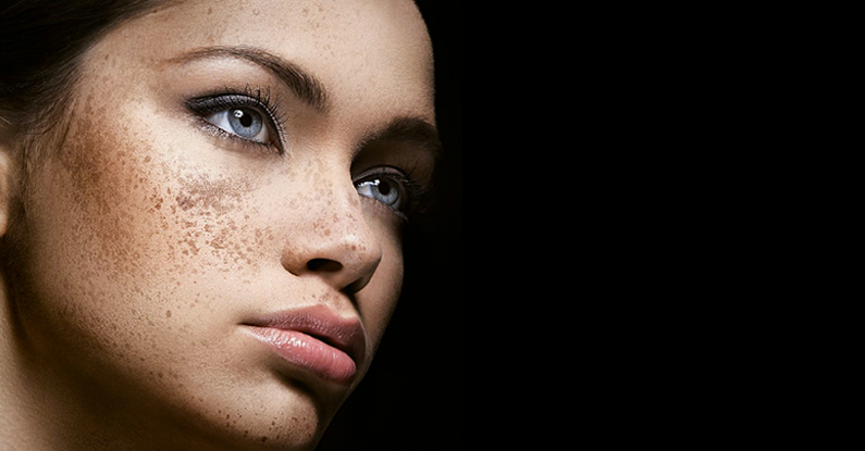 How to treat Melasma? Advice from Dr. Irwin