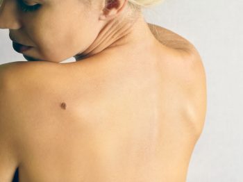What you need to know about moles lumps and bumps on skin by Dr. Brandith Irwin on SkinTour