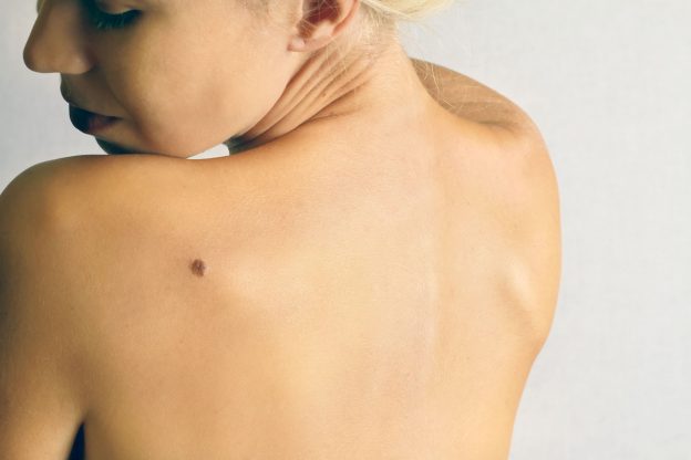 What you need to know about moles lumps and bumps on skin by Dr. Brandith Irwin on SkinTour