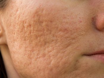 Face scars from acne and picking - finding a treatment plan that actually works - by Dr. Brandith Irwin on SkinTour