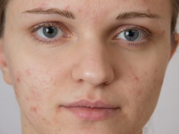 Accutane and acne Dr. Irwin answers on skintour